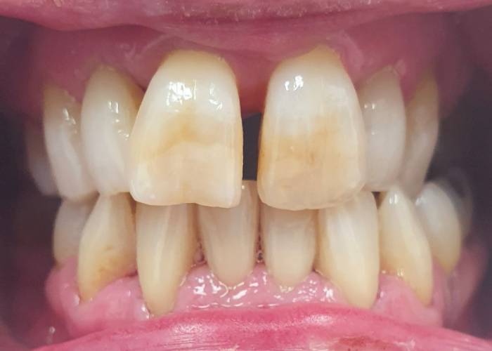 whitening-dental-case-study-before.jpg